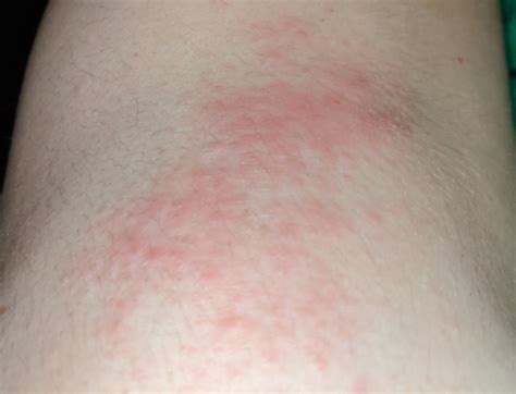 Mysterious Rash Dermatology Forums Patient