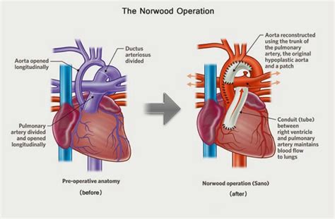 Norwood Procedure Treatment And Cost Guide