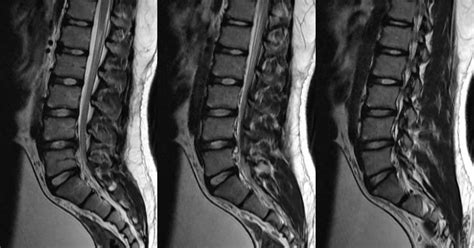 Neuroradiology Cases Discal Cyst Mri Lumbar Spine