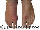 How To Get Gout Under Control Images