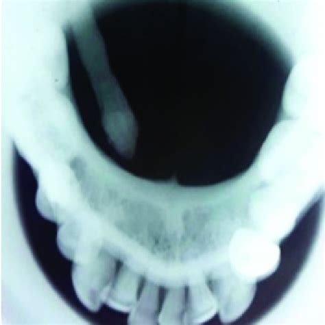 Occlusal View Radiograph Showing Submandibular Sialolith Of Case 1