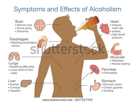 Symptômes Et Effets Du Patient Alcoolique Image Vectorielle De Stock Libre De Droits 1027527763