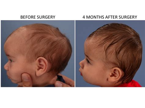 Sagittal Synostosis Scaphocephaly — Dallas Plastic Surgeon