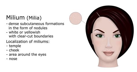 Causes And Treatment For Milia An Aesthetic Doctor Discusses Human