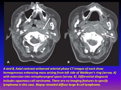 Presentation1pptx Radiological Imaging Of Extra Nodal Lymphoma