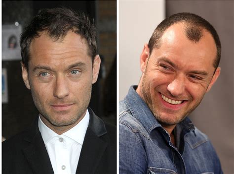 Celebrity Hair Loss Before And Pictures Bald