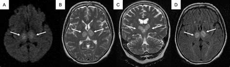 Cureus Bilateral Thalamic Ischemic Stroke Secondary To Occlusion Of