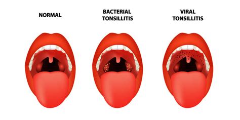 Healthy Tonsils Vs Unhealthy Tonsillitis Causes Symptoms Treatment