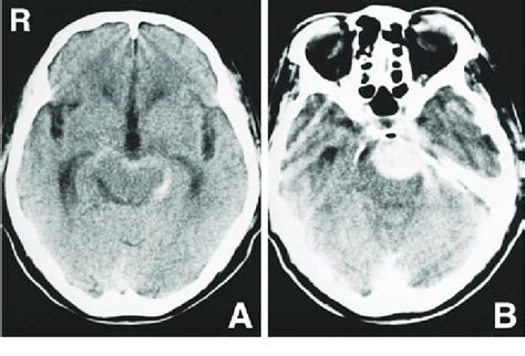 A Computed Tomography Ct Scan Showing Subarachnoid Hemorrhage In The