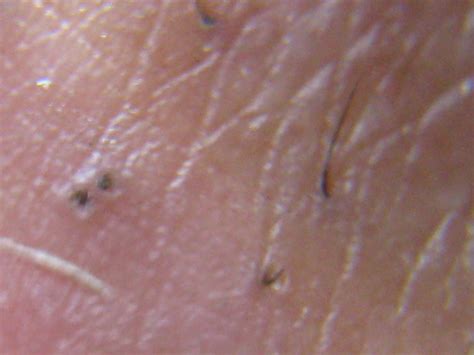 What Is Morgellons Disease Perfect Therapy