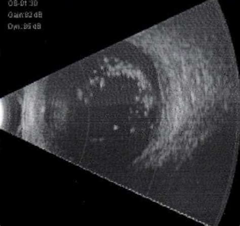 Figure Ultrasound B Scan Image Of An Statpearls Ncbi Bookshelf