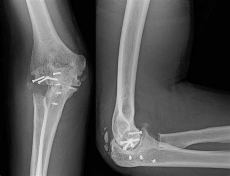 Clinical Outcomes Of Anconeus Interposition Arthroplasty After Radial