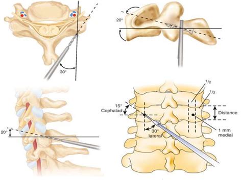Lateral Mass Screws Fixation Of Cervical Spine موقع الاستاذ الدكتور