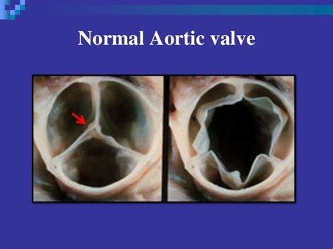 What Is The Normal Aortic Valve Area