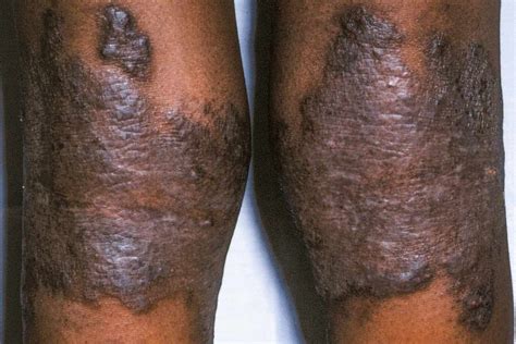 Eczema On Dark Skin Appearance Diagnosis Management