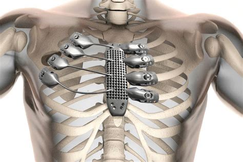 World First Operation Implants 3d Printed Titanium Ribcage And Stern