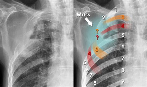 Chest X Ray Lung Cancer Bone Disease