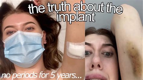 Getting My Implant Removed AND REPLACED After Years My Experience YouTube