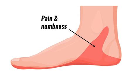 Tarsal Tunnel Syndrome Pain