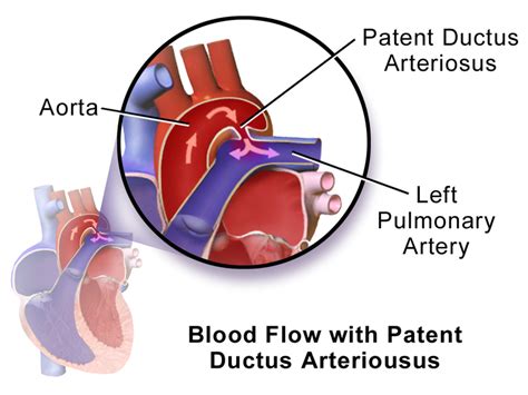 A personal digital assistant, also known as a palmtop computer, or personal data assistant, is a mobile device that functions as a personal. Patent ductus arteriosus | PDA ~ Cardiovascular Nurse