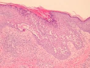 Pemphigus vulgaris pathology | DermNet NZ