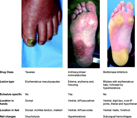 Clinical Presentation And Management Of Handfoot Skin Reaction