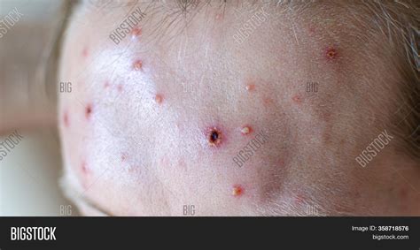 Large Spots Pimples Image And Photo Free Trial Bigstock