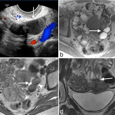 Sagittal Transabdominal Pelvic Ultrasound Shows An Irregular Mass