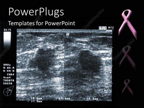 Symptoms of inflammatory breast cancer include swelling (edema) and redness (erythema) that affect a third or more of the breast. PowerPoint Template: ultrasound depiction of breast tumor ...