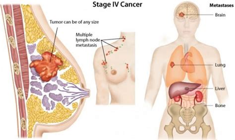You may find pink or reddened areas often with the texture and thickness of an orange. Inflammatory Breast Cancer Pictures with Different Symptoms