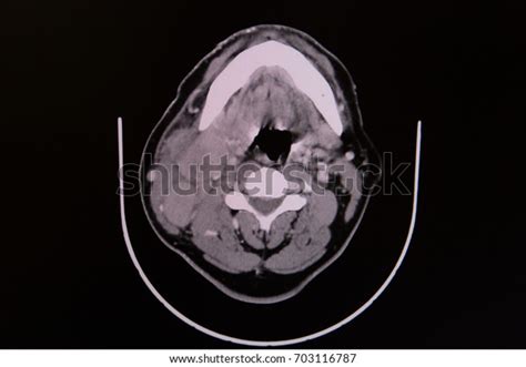 Ct Scan Neck Showing Enlarged Multiple Stock Photo Edit Now 703116787