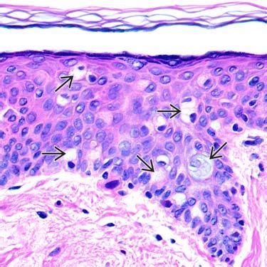 Toker cells - Humpath.com - Human pathology