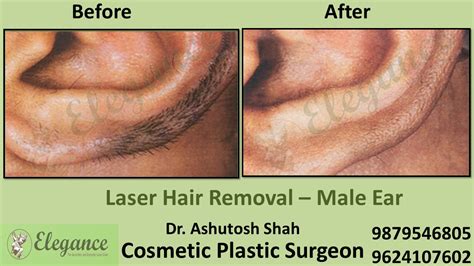 Ear Hair Removal With Laser In Surat Gujarat