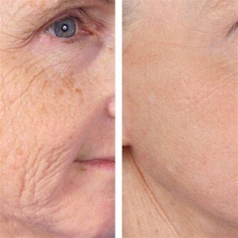 Skin Laser And Cosmetic Clinic Adelaide Visible Changes