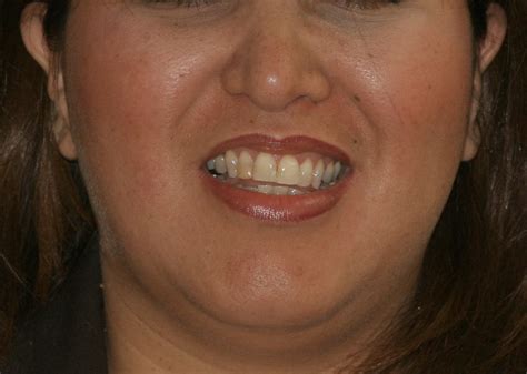 Orthodontics And Facial Beauty Part Iii Tilted Teeth — Austin