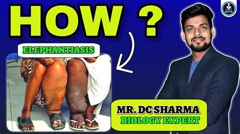 Elephantiasis Disease General Biology Neet 720 Dc Sir Youtube