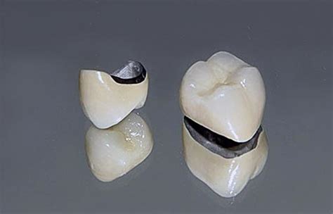 PFM Crowns - Stodament Dental Laboratory