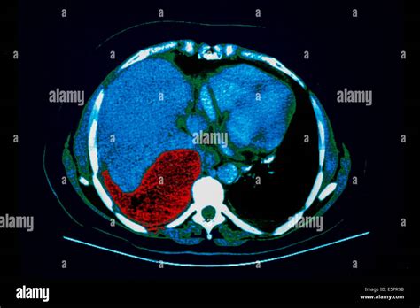 Axial Computed Tomography Ct Scan Of The Abdomen Showing A Large Lung