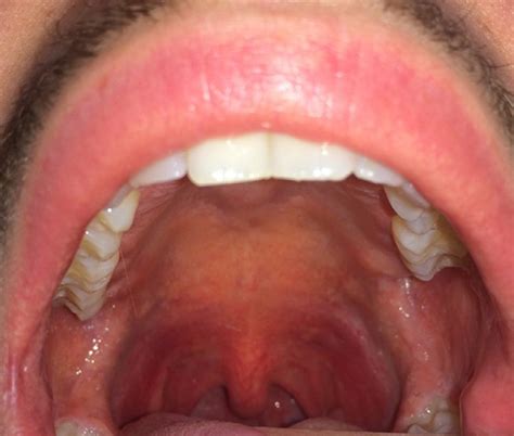 Diffuse Erythema With Petechiae Involving The Soft Palate During
