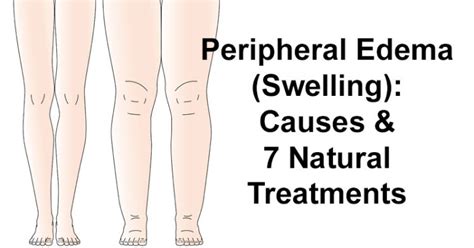 Peripheral Edema Swelling Causes And 7 Natural Treatments David