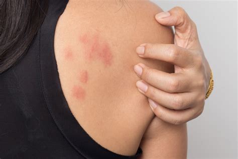 Stress Rash What It Is How To Treat And Prevent
