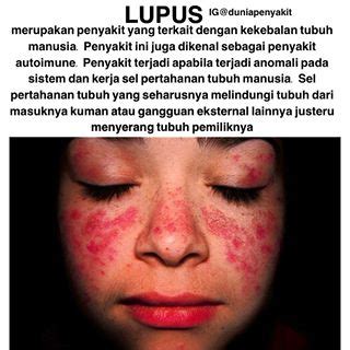 Lupus Eritematosus Sistemik Panduan Praktik Klinis Bagi Dokter