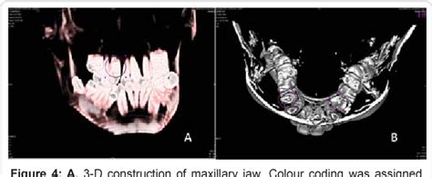 Figure 4 From Autotransplantation Of An Impacted Second Premolar In Its