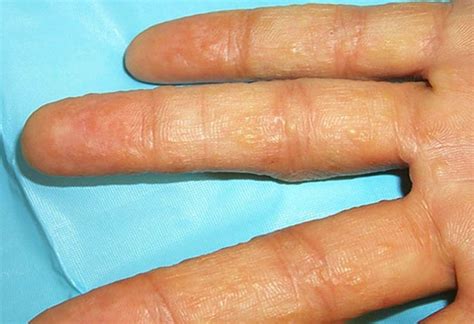 Eczema on hands secrets explained simply by dr.sal. Dyshidrotic Eczema - Pictures, Contagious, Treatment ...