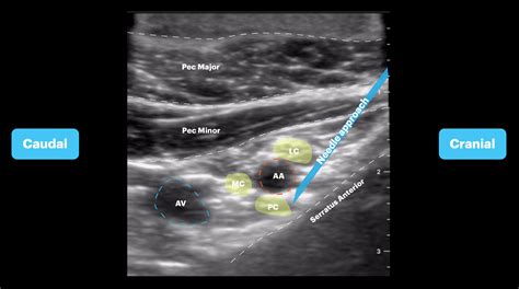 Infraclavicular Block