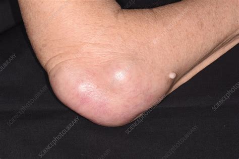 Bursitis Of The Elbow Stock Image C0515770 Science Photo Library