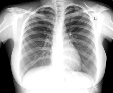 肺纹理增粗到底是什么原因，为什么现代人拍片经常会出现这种疾病