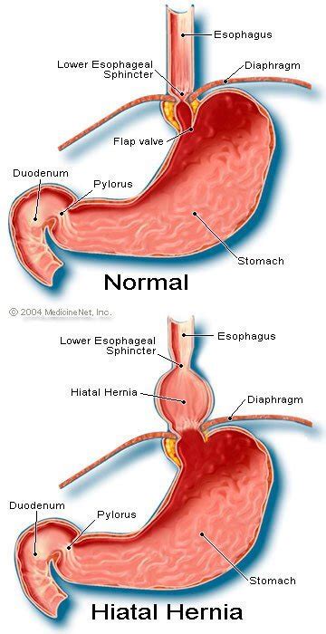 Heart Attack Or Hiatal Hernia Differences In Symptoms And Signs