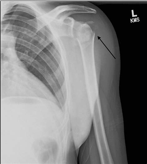 Cureus An Irreducible Posterior Fracture Dislocation Of The Shoulder A Case Report