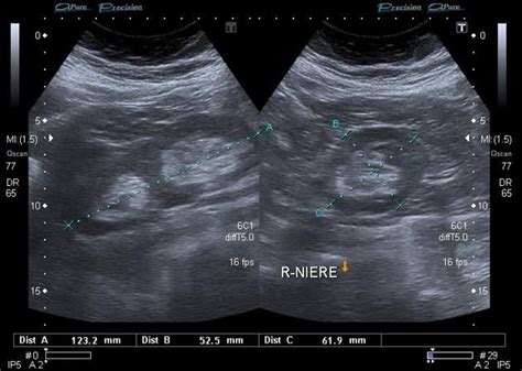 Greyscale Ultrasound Shows The Typical Appearance Of A Duplex Kidney